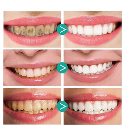 Teeth Whitening Foam (1+1 GRATIS)